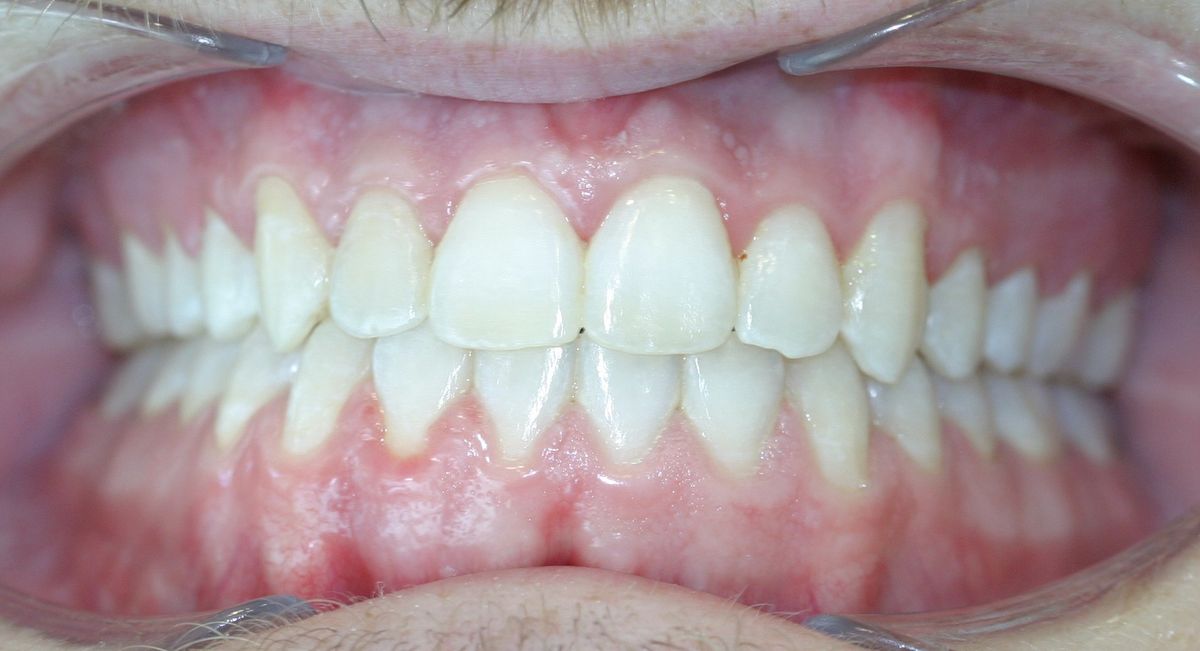 Before and after orthodontic treatment